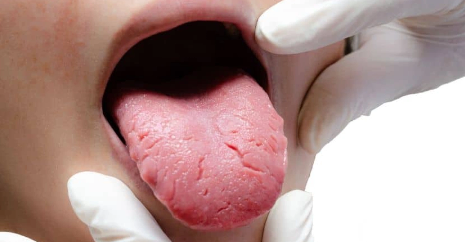 burning mouth syndrome 2